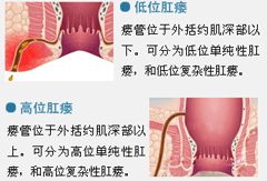 肛瘘分类.gif